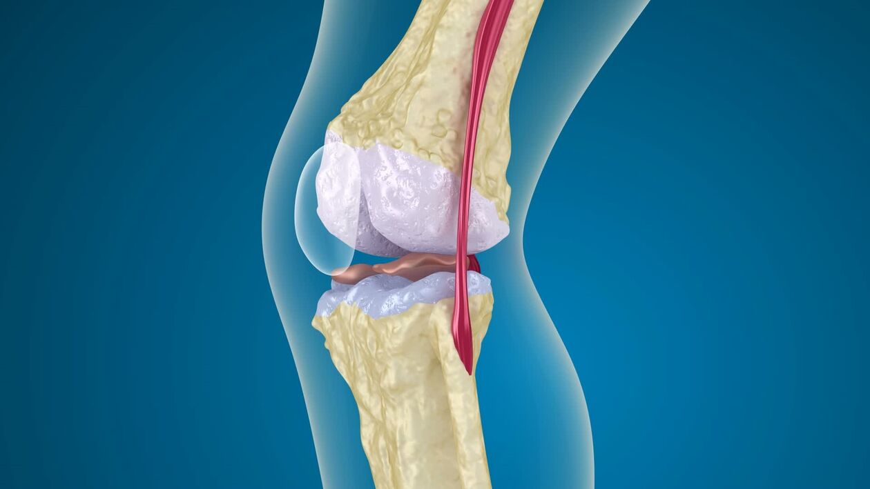 destruction of the knee joint with arthrosis