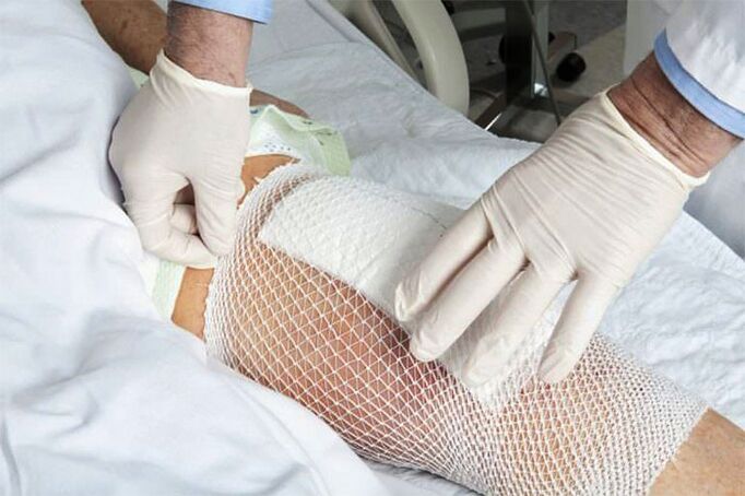 Therapeutic poultice for arthrosis of the knee joint