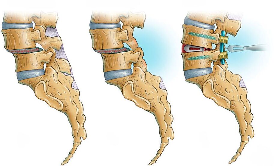 spinal deformity