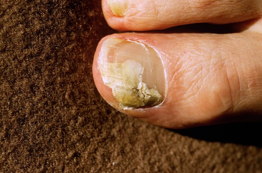 Onchomycosis