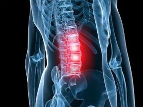 The lumbar spine osteochondrosis