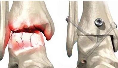 The joint surgical treatment of the knee