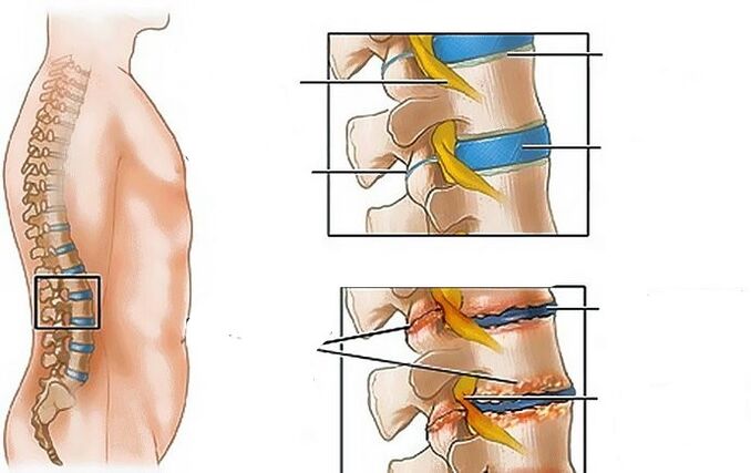 The lumbar region osteochondrosis