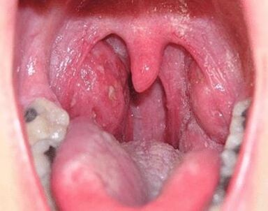 If you have a sore throat, your neck and throat are sore