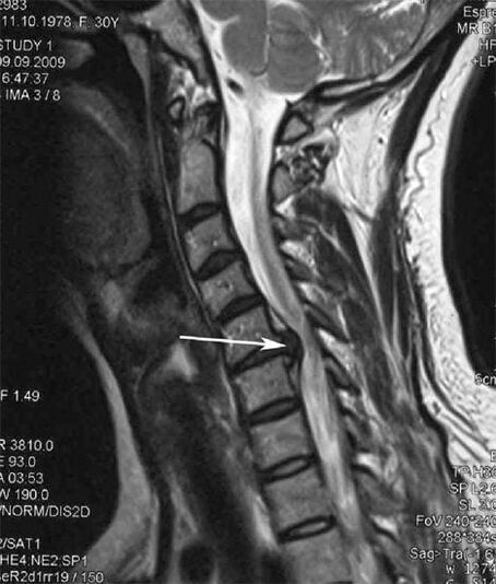 Injury to the spinal cord causes neck pain