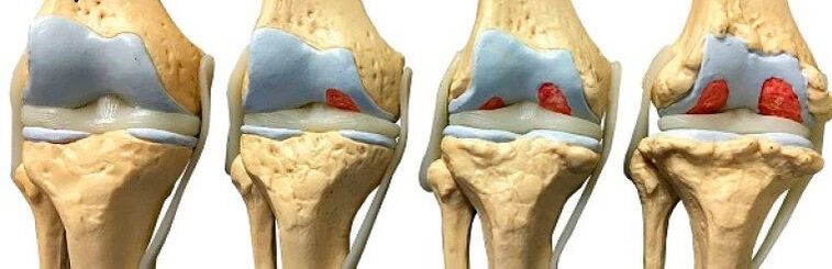 stages of knee arthrosis