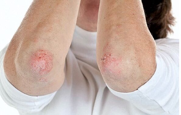 People with psoriasis are prone to arthritis