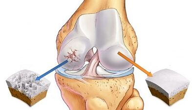 Causes of arthrosis of the joints