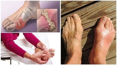 What is arthritis in the arthritis