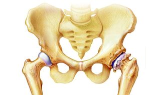 why does hip arthrosis occur